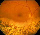 Retinitis Pigmentosa